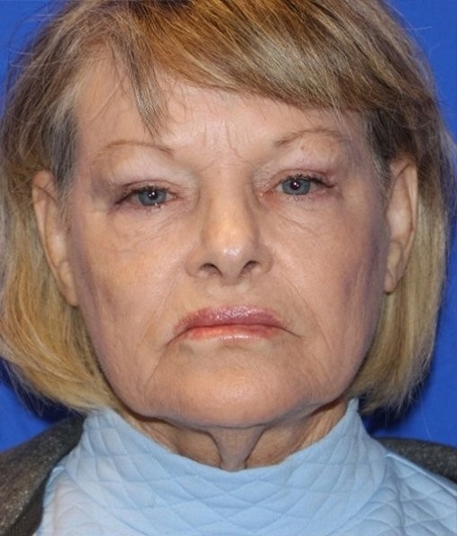 Patient Neck Lift Before 0