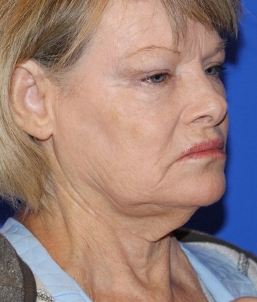 Patient Neck Lift Before 1