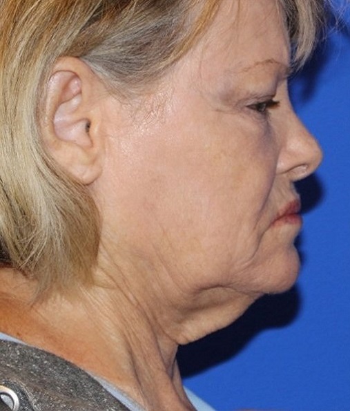 Patient Neck Lift Before 2