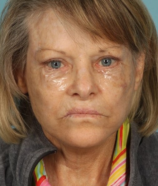 Patient Neck Lift Before 0