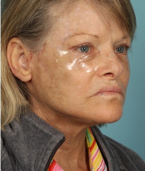 Patient Neck Lift Before 1