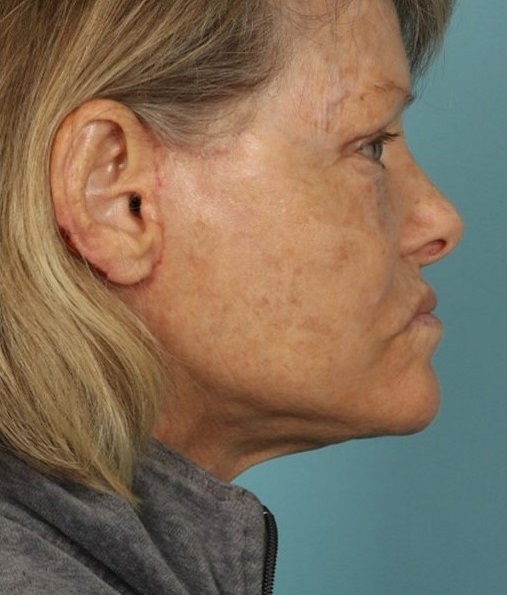 after neck lift side view female case 1158