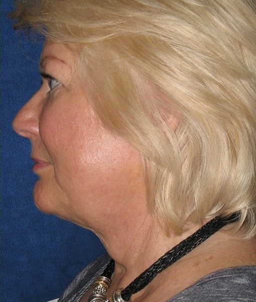 after neck lift side view female case 1172
