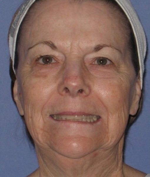Patient Neck Lift Before 0