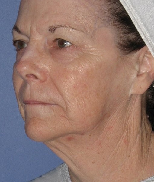 Patient Neck Lift Before 1