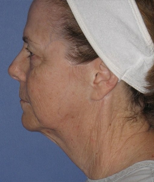 before neck lift side view female case 1180