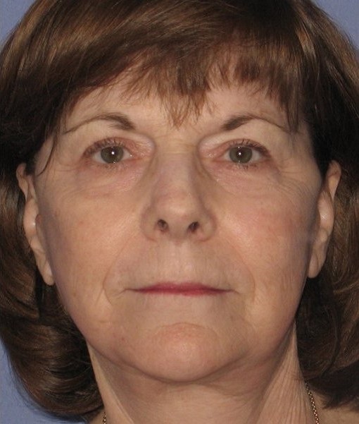 Patient Neck Lift Before 0