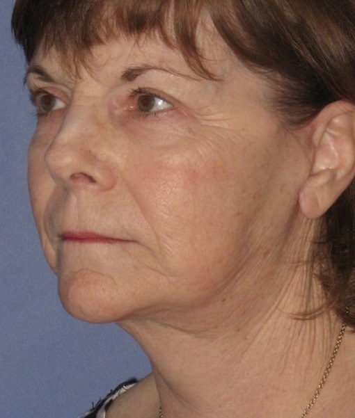 Patient Neck Lift Before 1