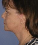 Patient Neck Lift Thumbnail After 2
