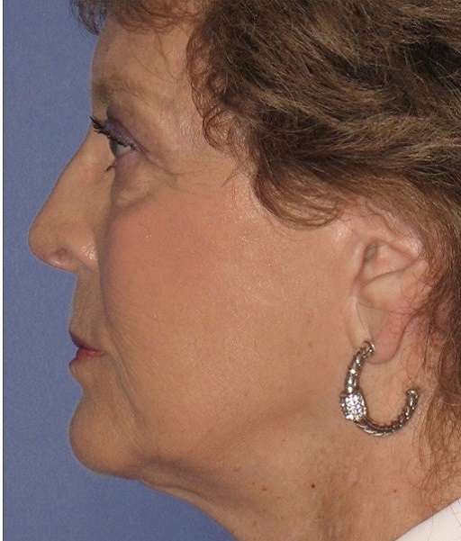 after neck lift female side view case 1187
