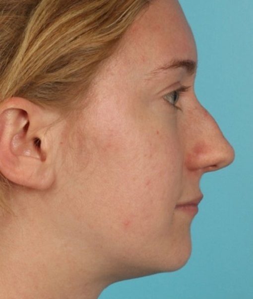 before rhinoplasty right side view of female patient 608 at Paydar Plastic Surgery