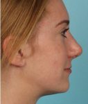 Patient Rhinoplasty Thumbnail After 2