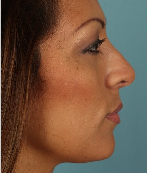 after rhinoplasty right side view of female patient 615 at Paydar Plastic Surgery