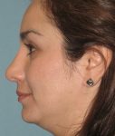 after rhinoplasty left side view of female patient 622 at Paydar Plastic Surgery