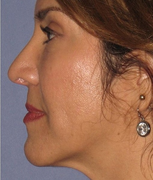 after rhinoplasty right side view of female patient 630 at Paydar Plastic Surgery