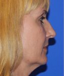 before rhinoplasty right side view of female patient 638 at Paydar Plastic Surgery