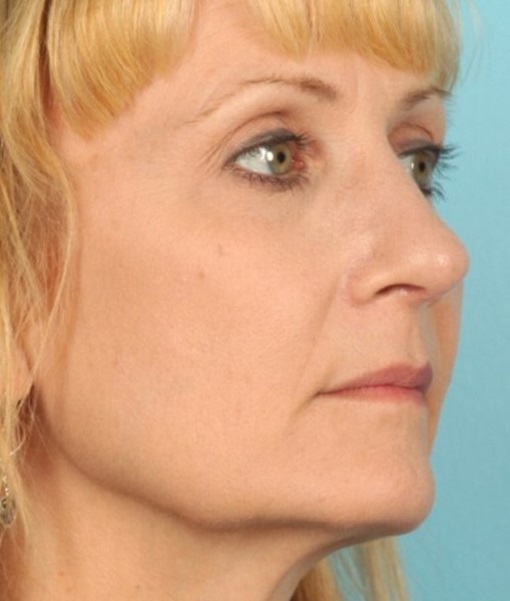 after rhinoplasty right angle view of female patient 638 at Paydar Plastic Surgery