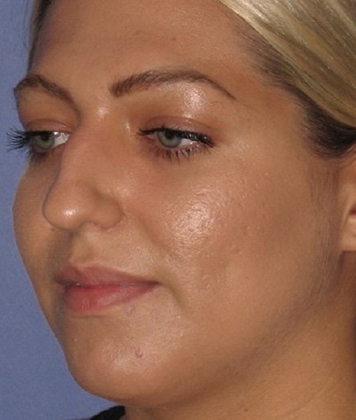 before rhinoplasty left angle view of female patient 646 at Paydar Plastic Surgery