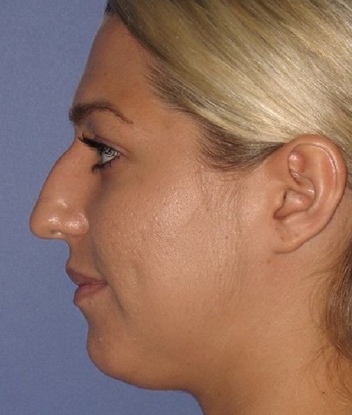 before rhinoplasty left view of female patient 646 at Paydar Plastic Surgery