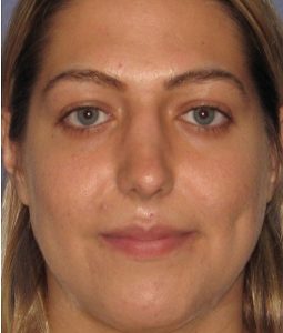 after rhinoplasty front view of female patient 646 at Paydar Plastic Surgery