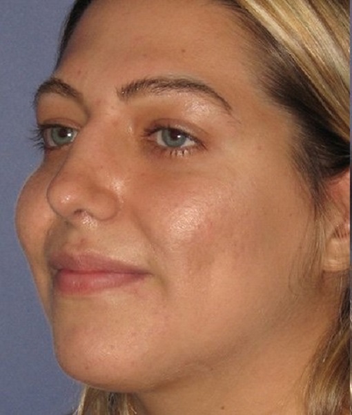 after rhinoplasty left angle view of female patient 646 at Paydar Plastic Surgery