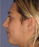 after rhinoplasty left view of female patient 646 at Paydar Plastic Surgery