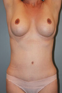 after tummy tuck tummy tuck front view female patient case 921