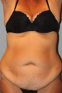 Patient Tummy Tuck Before 0