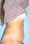 after liposuction female side view case 791