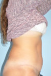 Patient Tummy Tuck Thumbnail After 2