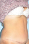 Patient Tummy Tuck Thumbnail After 1