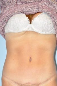 Patient Tummy Tuck After 0