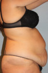 Patient Tummy Tuck Thumbnail Before 2