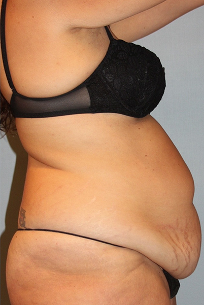 Patient Tummy Tuck Before 2
