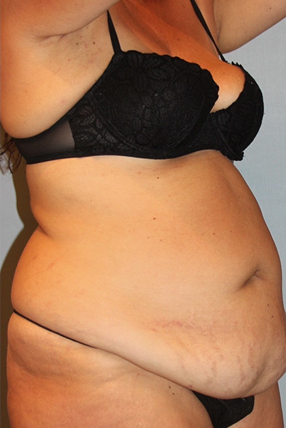 Patient Tummy Tuck Before 1
