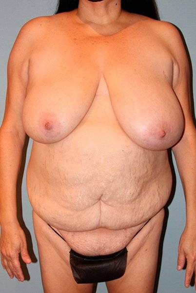 before tummy tuck front view of female patient 443 at Paydar Plastic Surgery