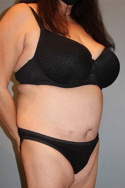 after tummy tuck right angle view of female patient 443 at Paydar Plastic Surgery