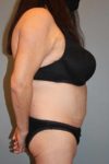 after tummy tuck right side view of female patient 443 at Paydar Plastic Surgery