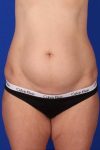 before tummy tuck front view of female patient 451 at Paydar Plastic Surgery