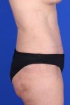 after tummy tuck right side view of female patient 451 at Paydar Plastic Surgery