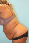 Patient Tummy Tuck Thumbnail Before 2