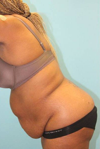 Patient Tummy Tuck Before 2