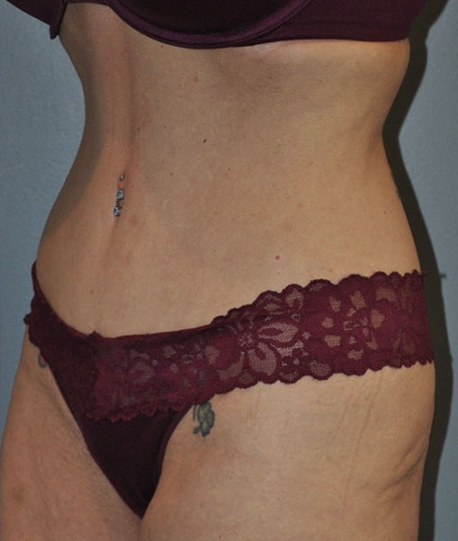 Patient Tummy Tuck Before 1