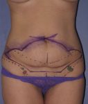 Patient Tummy Tuck Thumbnail Before 0