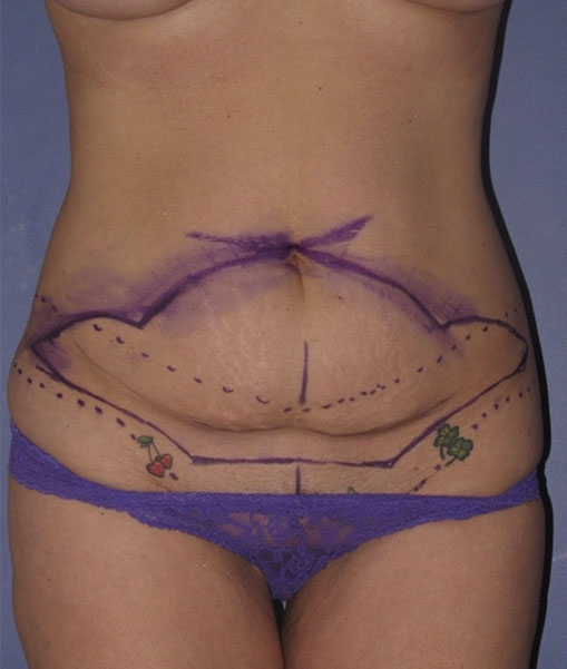 Patient Tummy Tuck Before 0