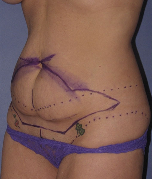 Patient Tummy Tuck Before 1
