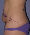 Patient Tummy Tuck Thumbnail Before 2