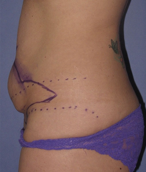 Patient Tummy Tuck Before 2