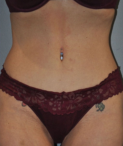 Patient Tummy Tuck Before 0