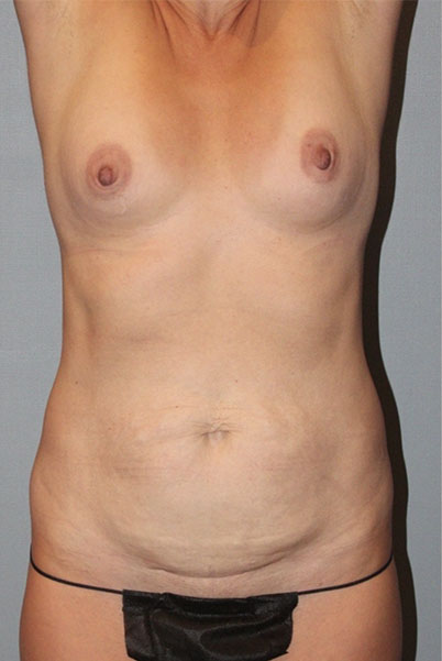 Patient Tummy Tuck Before 0